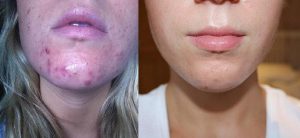 What's the Best Acne Facial Near Me | Phoenix | Inspire Day Spa